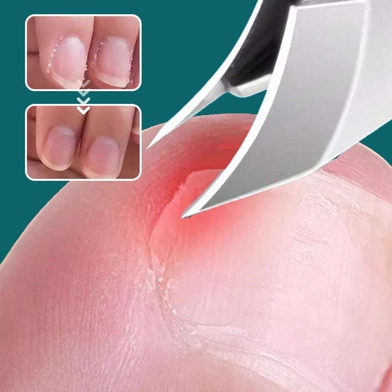 💅 Nagelpflege-Set für dicke & eingewachsene Nägel – Präzision & Langlebigkeit in einem! ✨